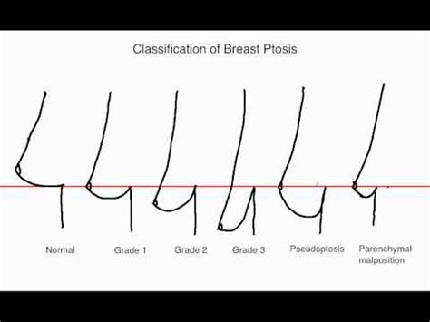 fallen boobs|Sagging Breasts (Breast Ptosis): Causes & Treatment .